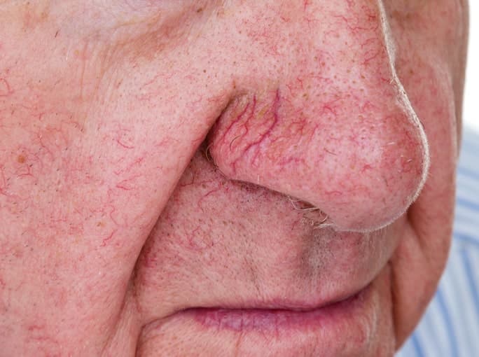 Man with spider veins on his nose