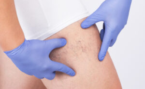 a doctor examining veins on a leg