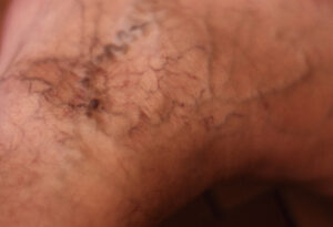 Close-up of purple and red varicose veins