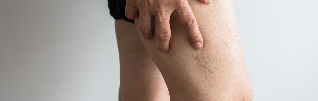 What you need to know about varicose veins