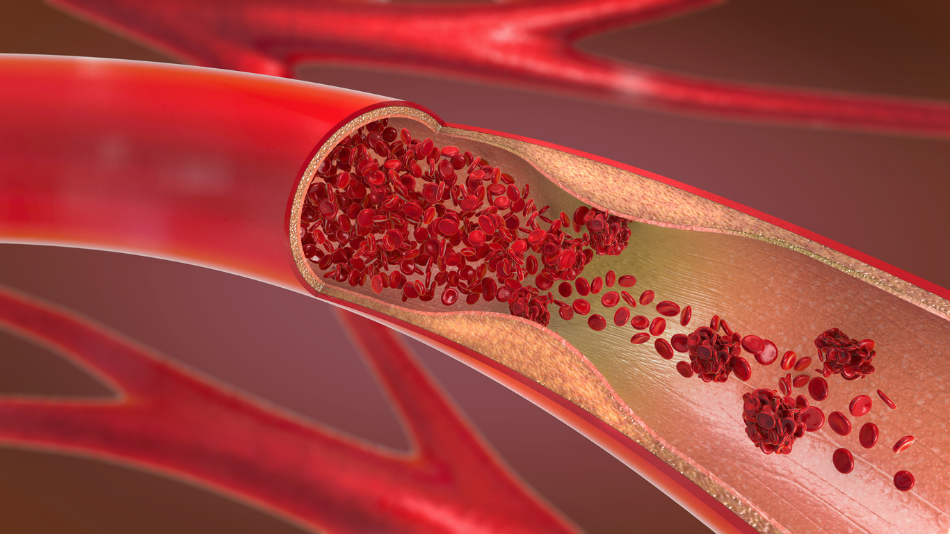 Can a Blood Clot in Your Leg Dissolve on Its Own?