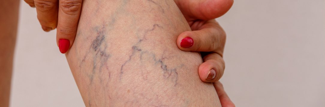 Are Spider Veins a Sign of Deeper Vascular Disease?