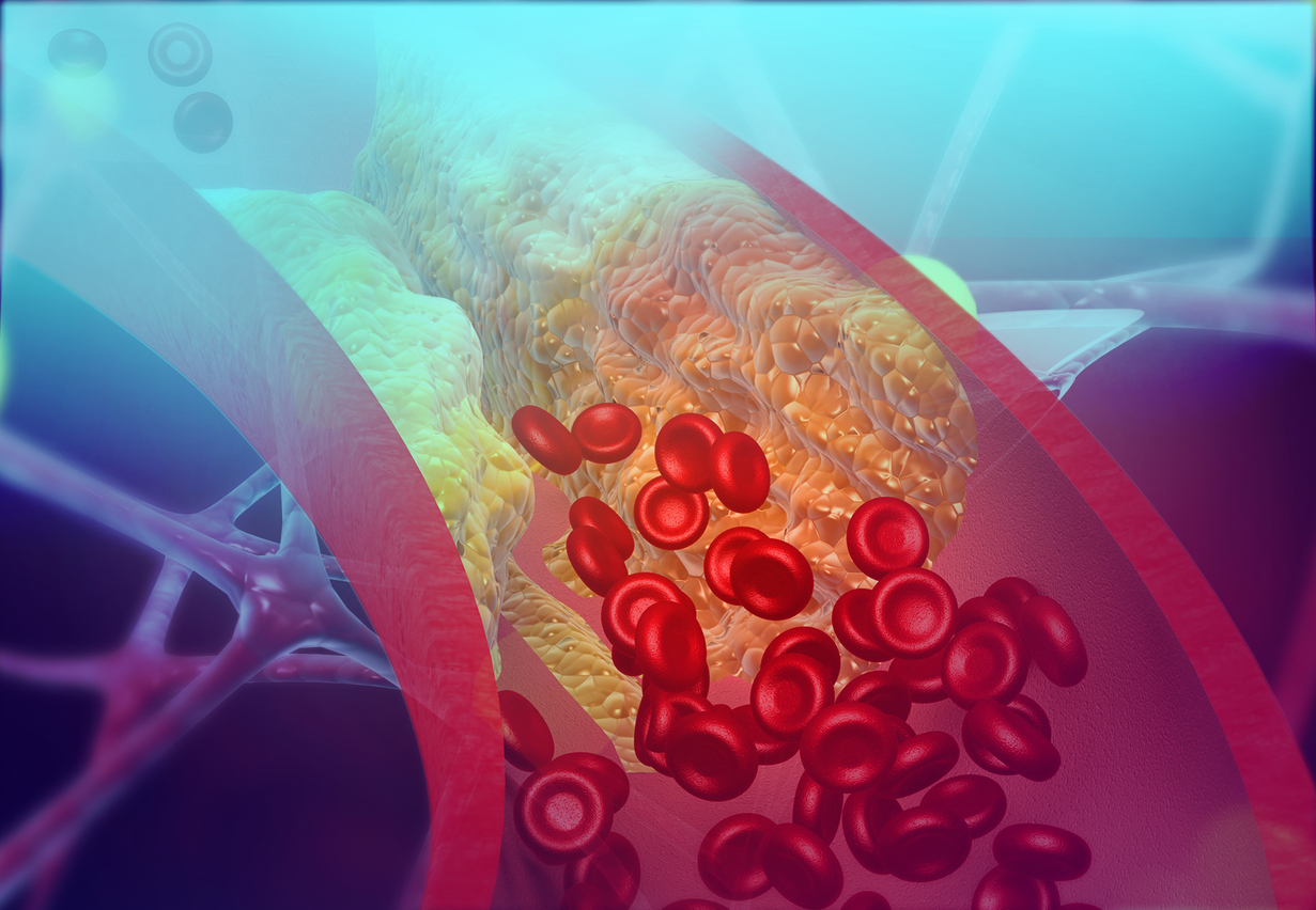 What Can You Do to Avoid Blood Clots?