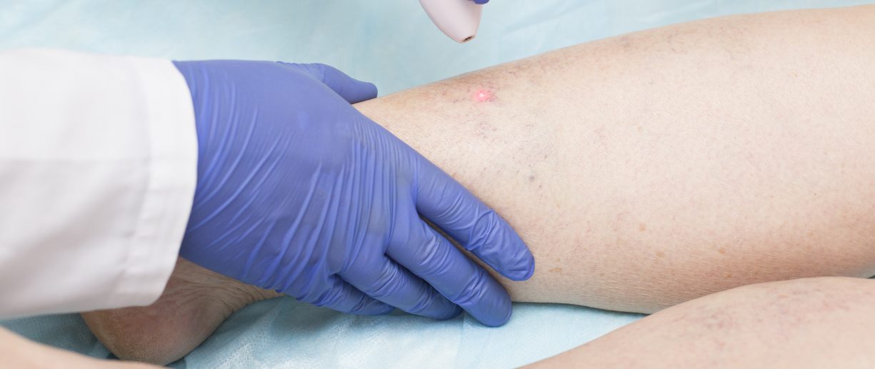 How Does Endovenous Laser Treatment Work for Varicose Veins?