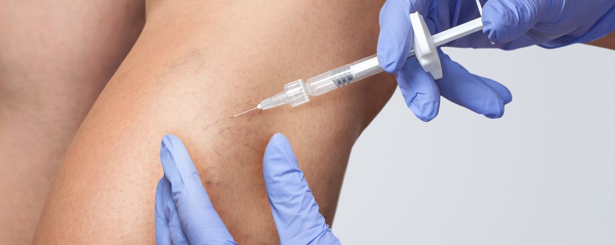 What You Shouldn’t Do After Your Sclerotherapy Procedure