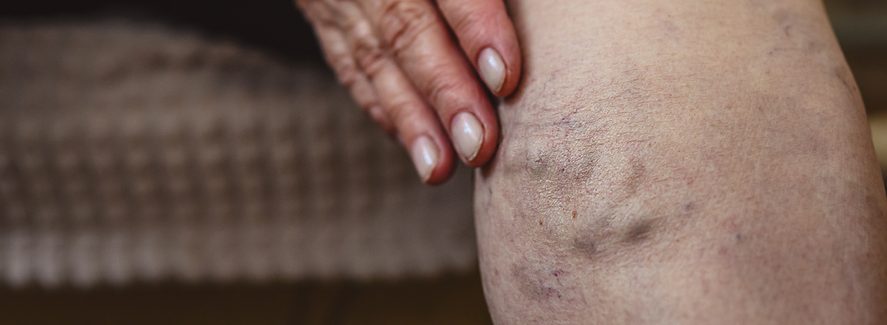 When should you consider removing varicose veins?