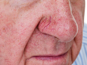 Close-up of man's nose with tiny red spider veins