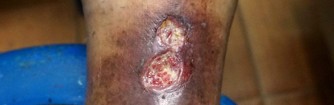 How Do You Tell if a Leg Ulcer is Infected?