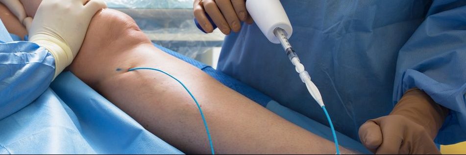 What Is the Best Vein Removal Treatment?