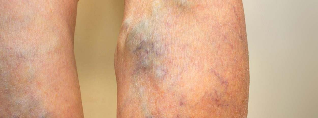 What You Need to Know About Varicose Veins