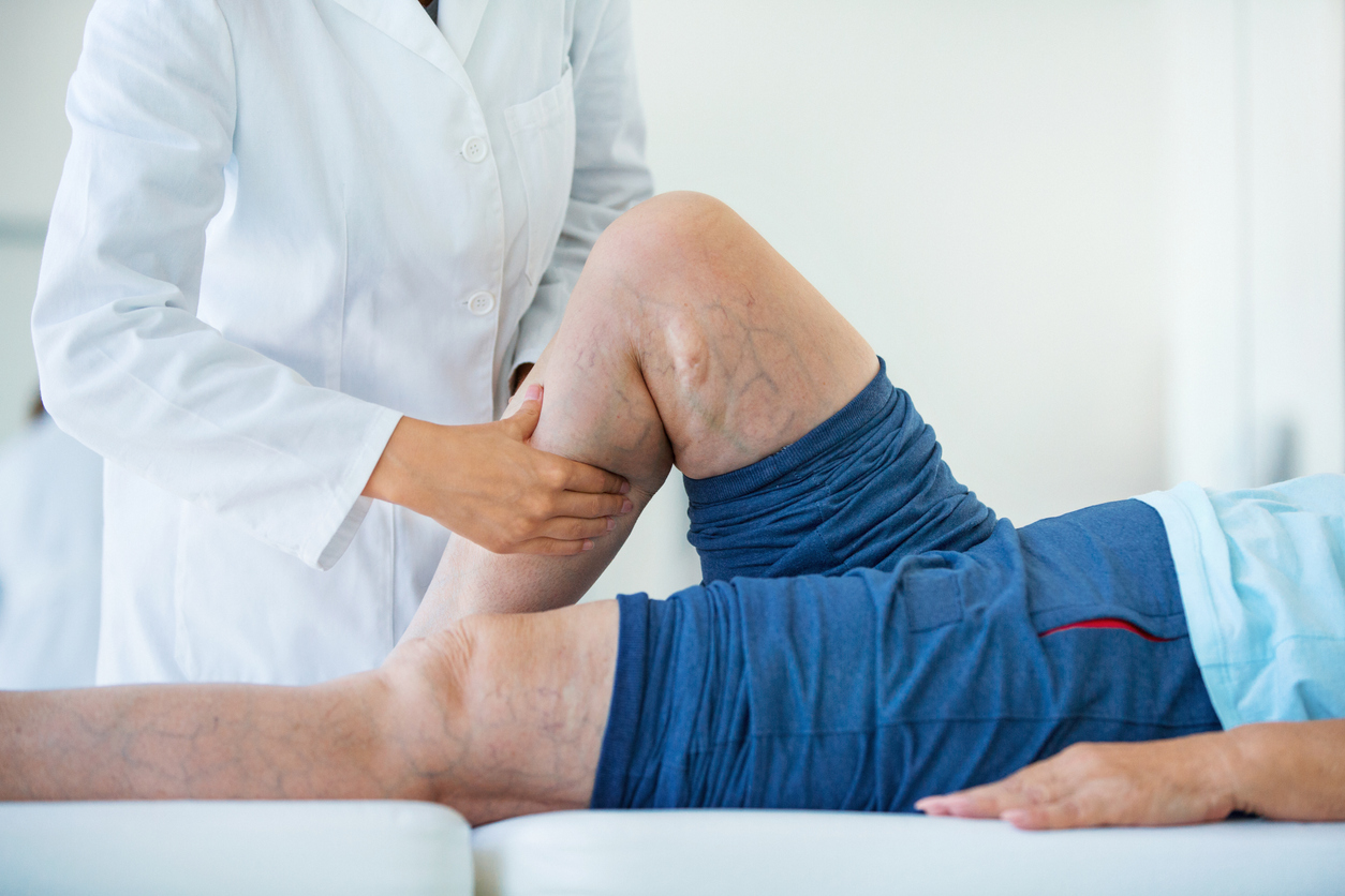The Link Between Lymphedema and Vein Health