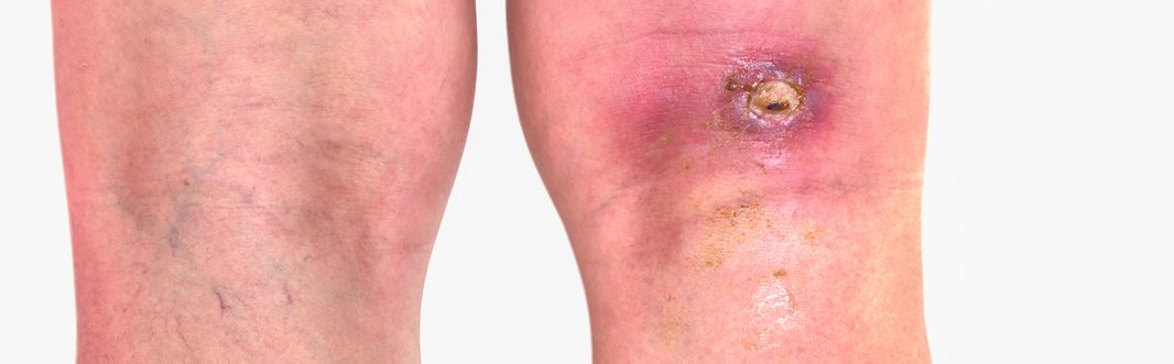 How Do You Treat an Ulcer on the Leg?