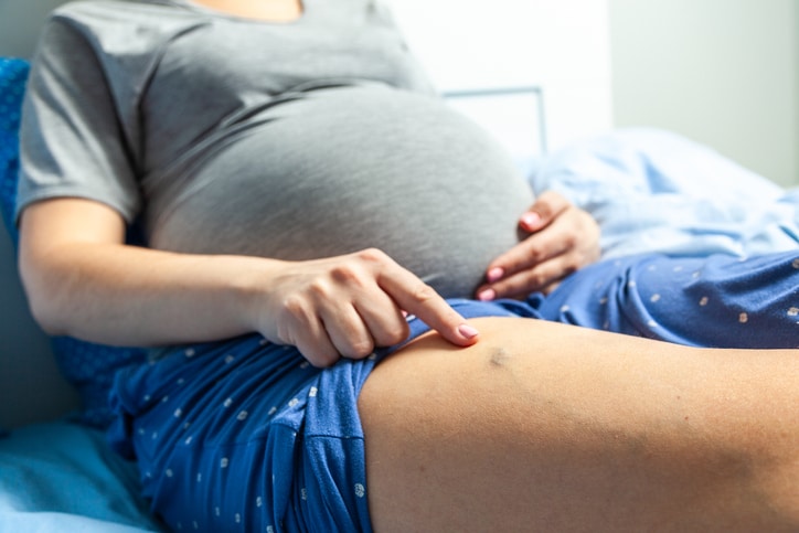 Photo of Varicose veins in pregnant women. Woman sits on bed and points her finger at swollen veins.