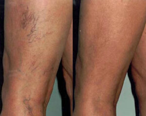 Photo of Spider vein removal before and after photo. Spider vein removal in thighs.