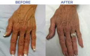 Photo of Hand vein removal before and after photo.
