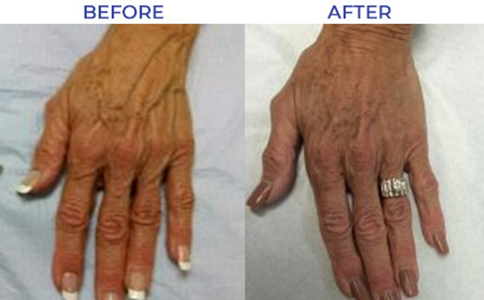 Vein Treatment Before & After Photos - Vein911®