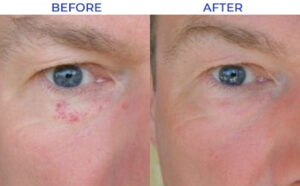 Photo of VeinGogh - facial vein removal treatment before and after photo.
