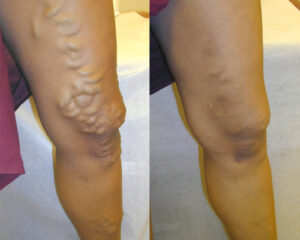 Varicose veins removal treatment before and after photo in legs.