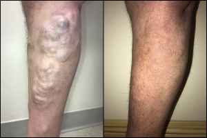 Varicose veins removal treatment before and after photo in legs.