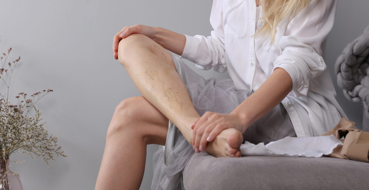 Do You Have Fatigue and Swollen Legs?