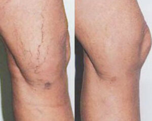 leg vein disease before and after