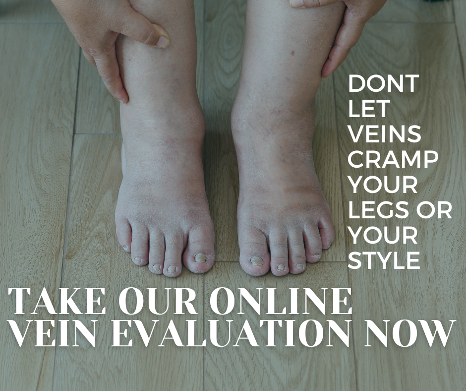 Causes of Swollen Legs, Ankles and Feet and How to Treat It Vein911®