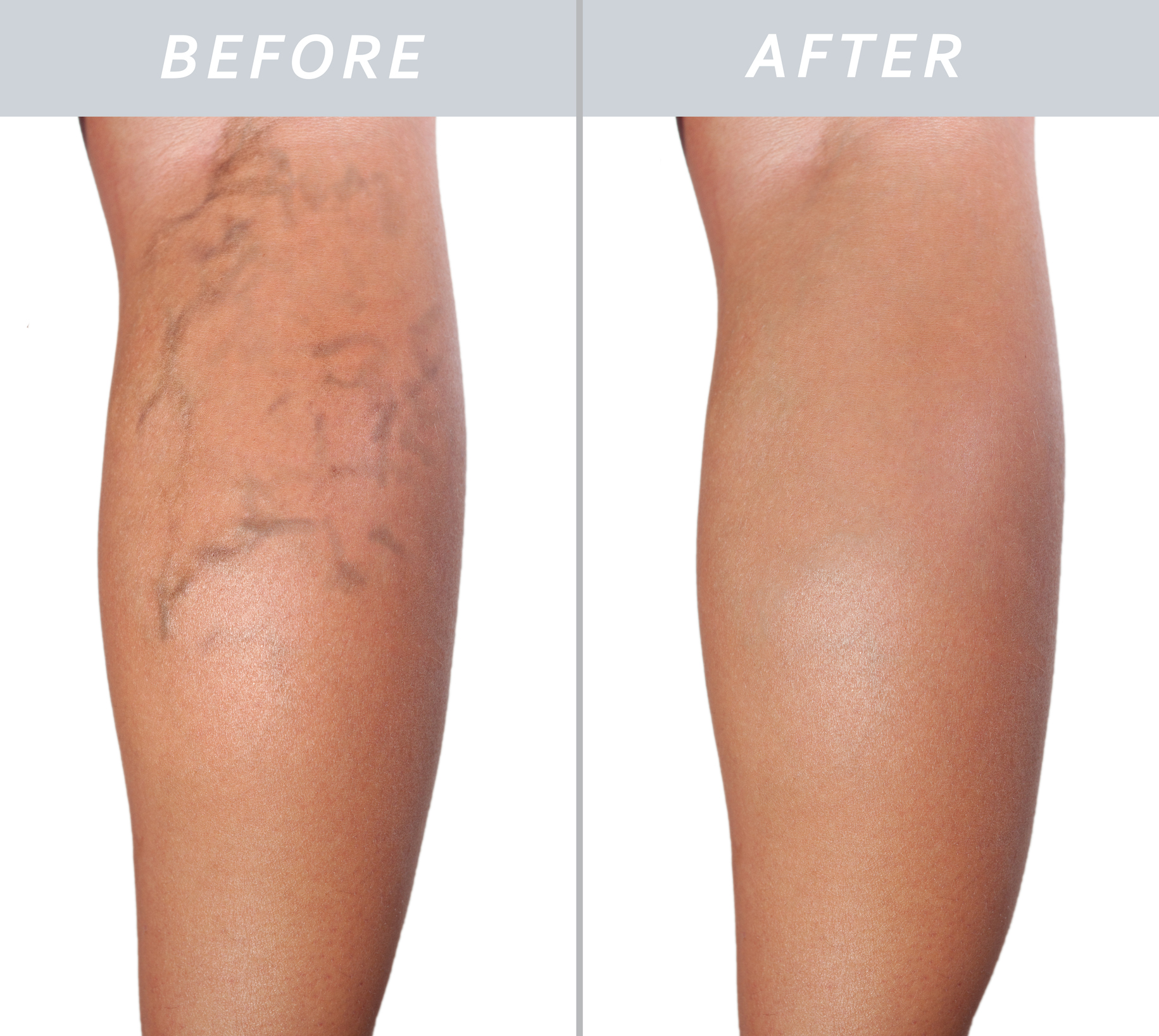In 10 Americans Have This Vein Problem – And You Might Too! - te5bzz5
