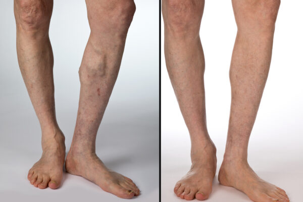 Before and after photos of mans left calf about 3 months after vascular surgery.