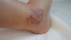 a swollen ankle with blister