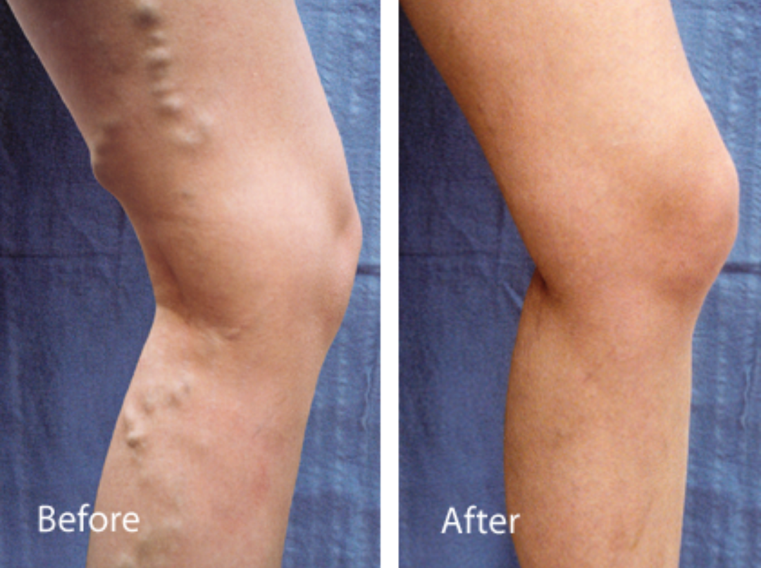 Vein Treatment Case Study - 40-year-old with Varicose Veins