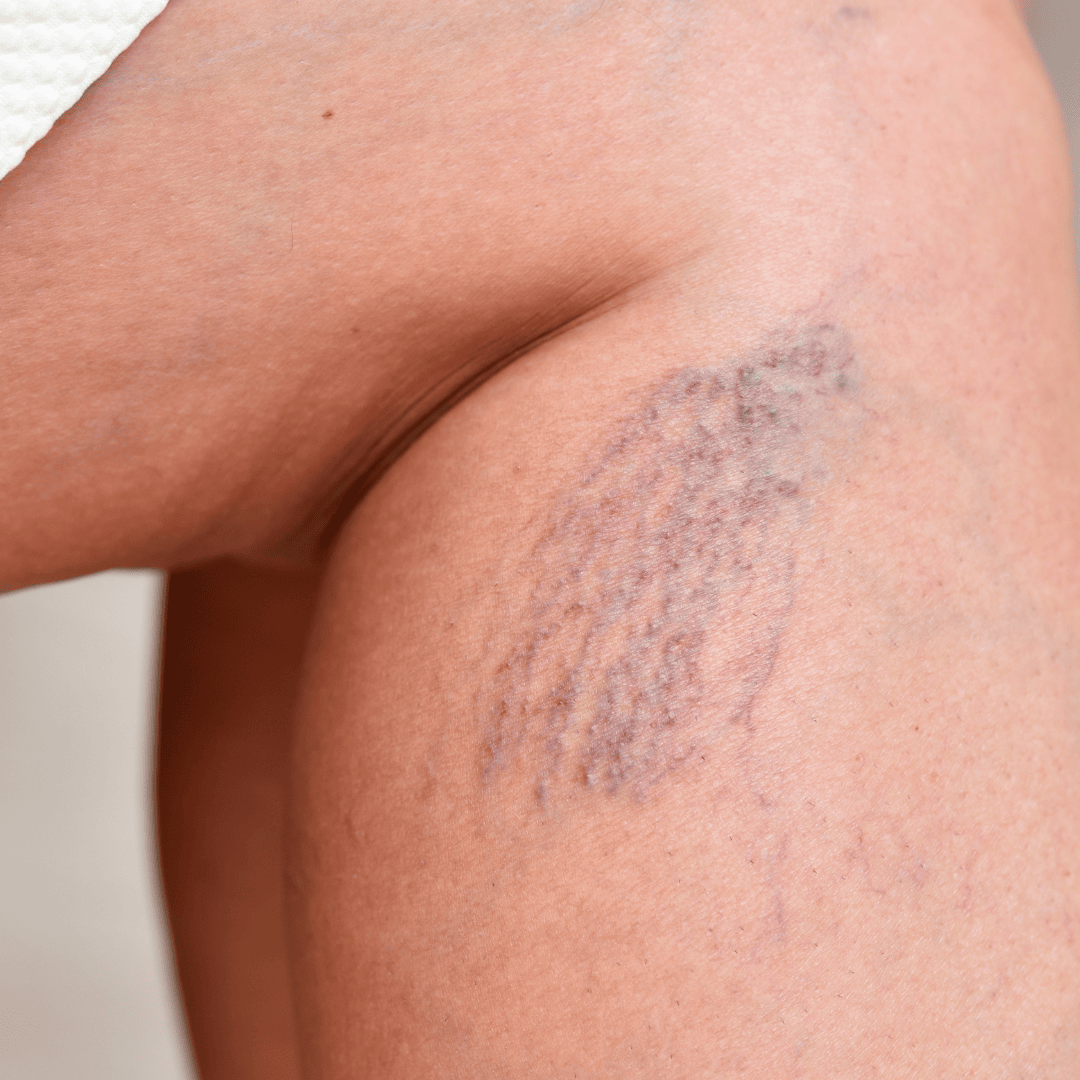 How to Get Rid of Spider Veins