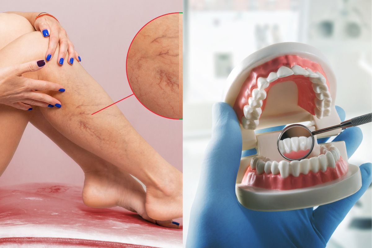 Comparison of Vein Health and Oral Health