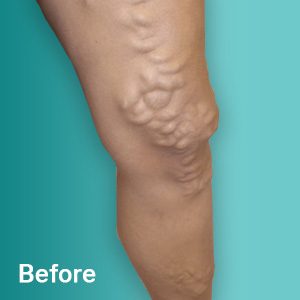 Before Varicose Vein Treatment Tampa FL