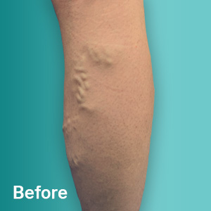 Before Varicose Vein Treatment Pinellas County FL