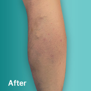 After Varicose Vein Treatment Pinellas County FL