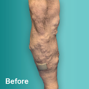 Before VenaThrive Varicose Vein Treatment Tampa FL