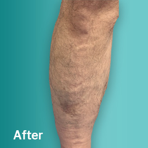 After VenaThrive Varicose Vein Treatment Tampa FL