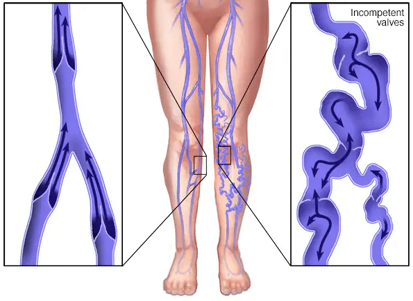 Varicose Vein Treatment Tampa FL
