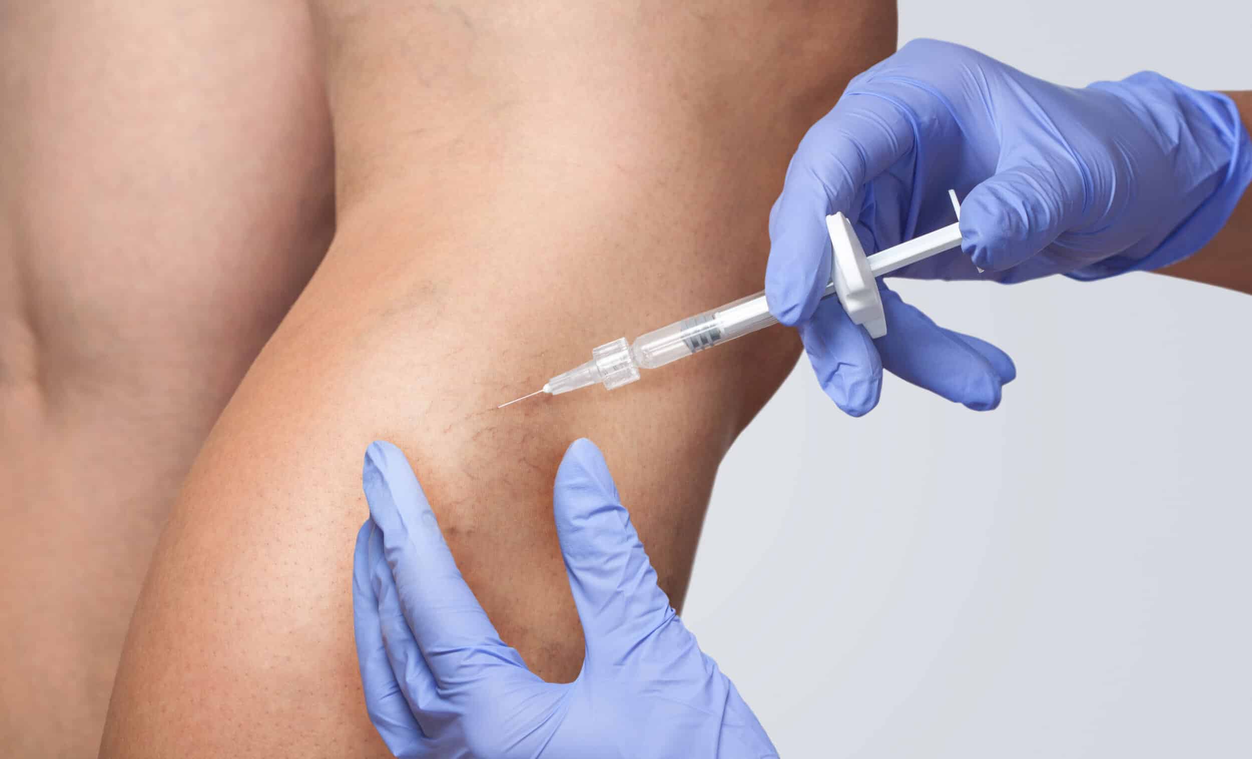 Close up of leg with veins getting sclerotherapy injections in Tampa, FL