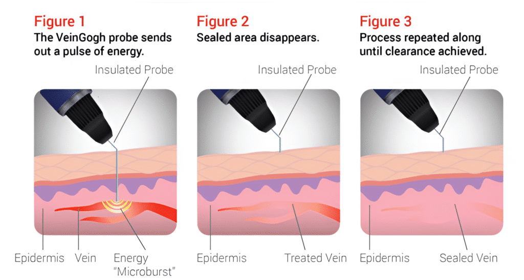VeinGough VeinGogh Treatment Tampa FL