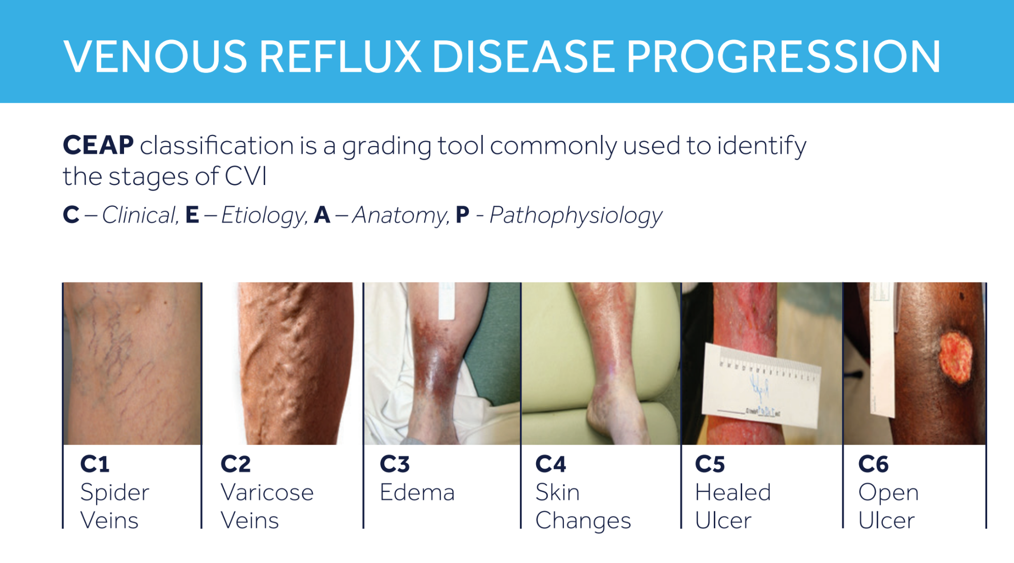 Diagram showing stages of vein disease from spider veins to an open ulcer