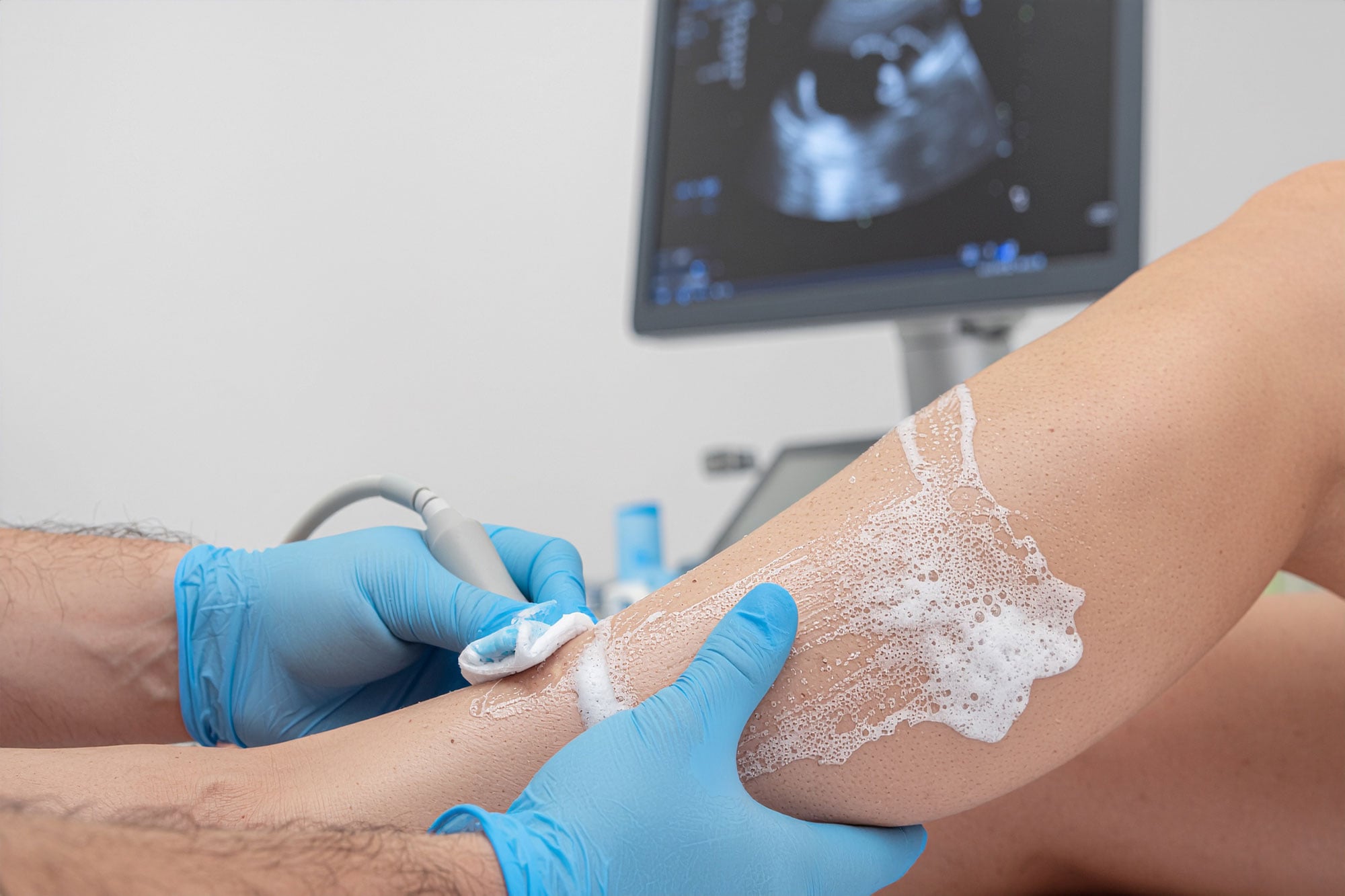 Ultrasound-guided foam sclerotherapy treatment
