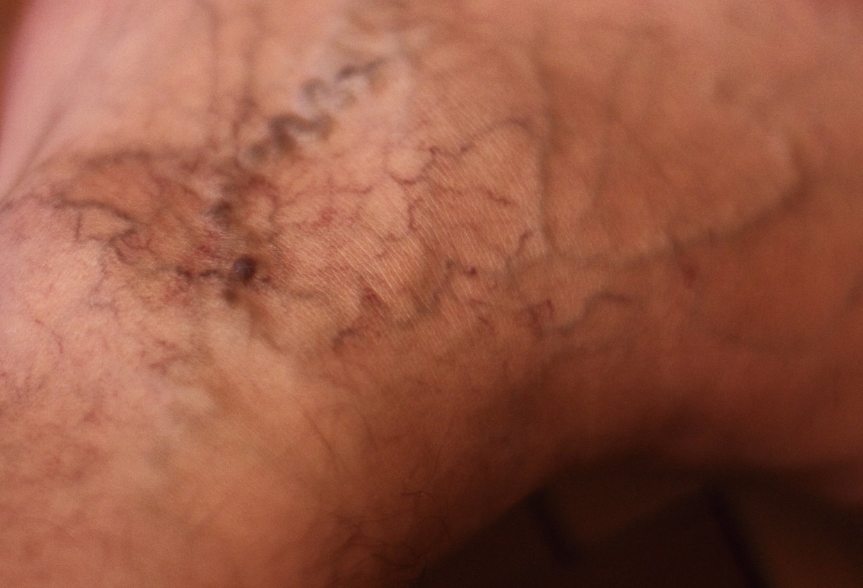 Can varicose veins pop? Vein911