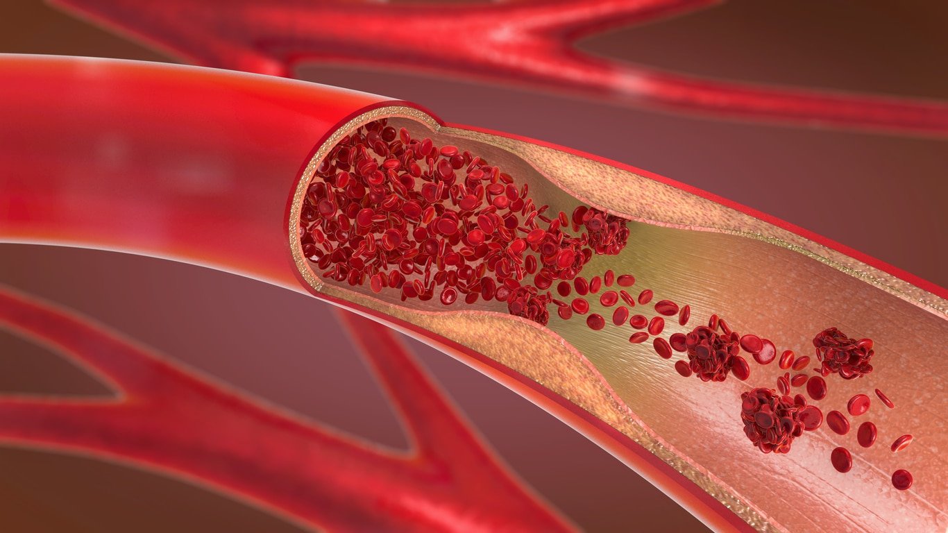 Photo of animated blood clot.
