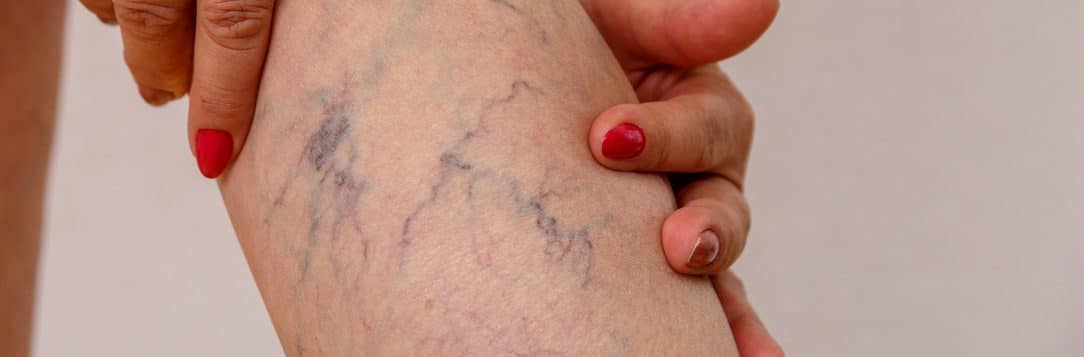 Photo of spider veins
