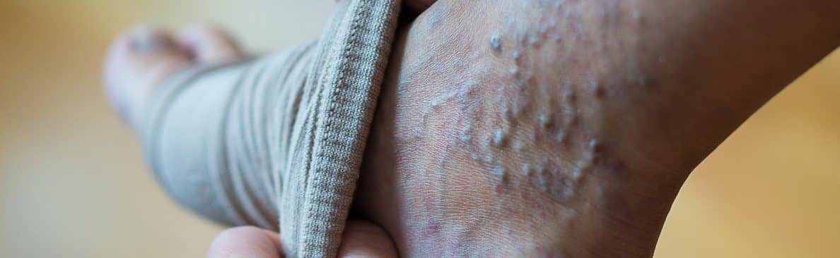 can compression socks be harmful?