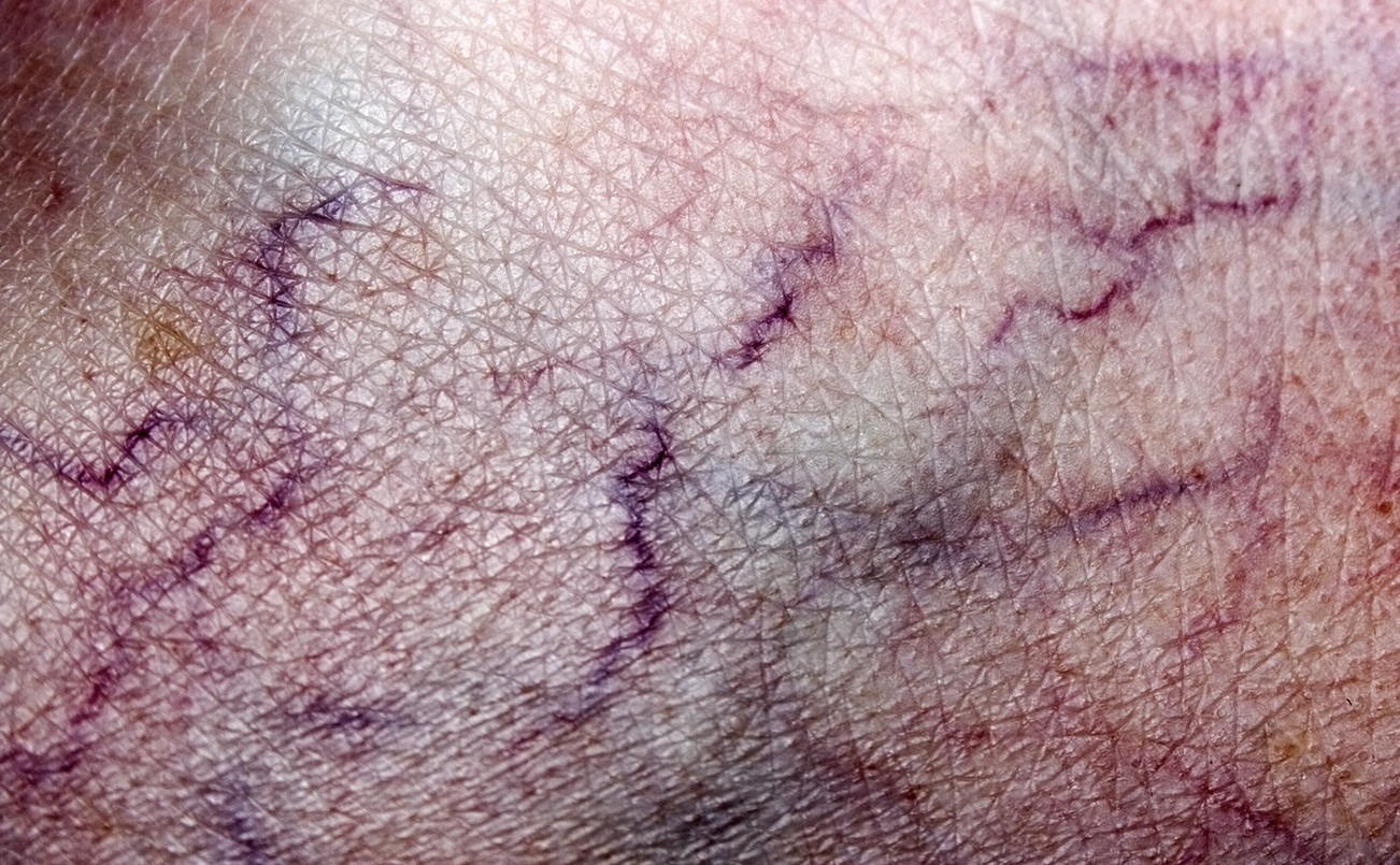varicose veins