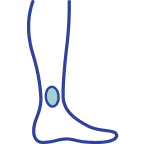 Ulcers Sores & Open Wound On Leg Treatment Tampa