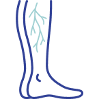 Leg Spider Vein Treatment Tampa