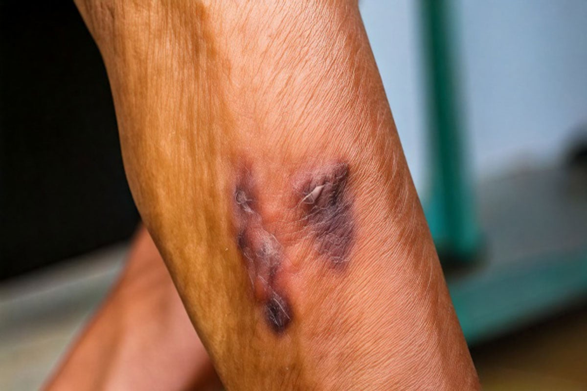 Close-up of an ulcer and skin discoloration on the lower leg